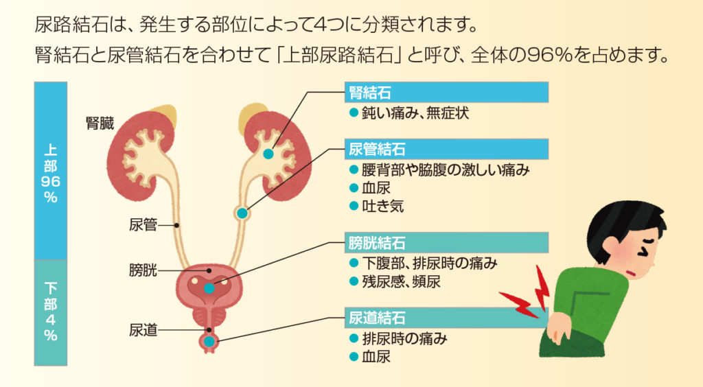 尿管結石になった　4/4